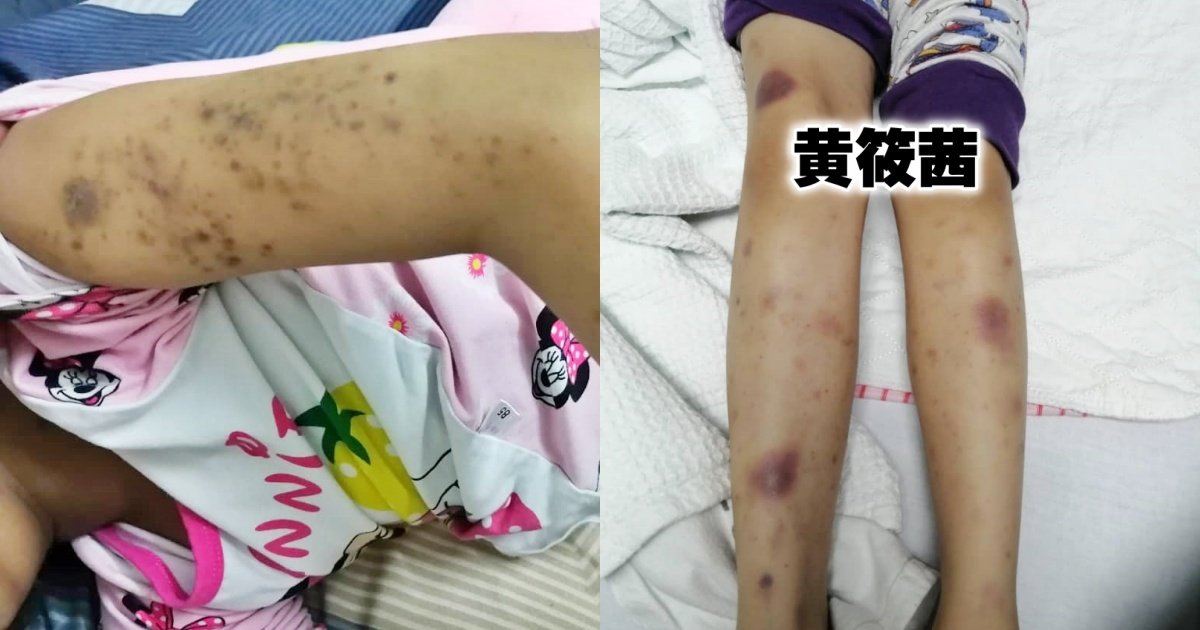 黄筱茜因体内缺乏血小板，双手及双脚处处淤青。